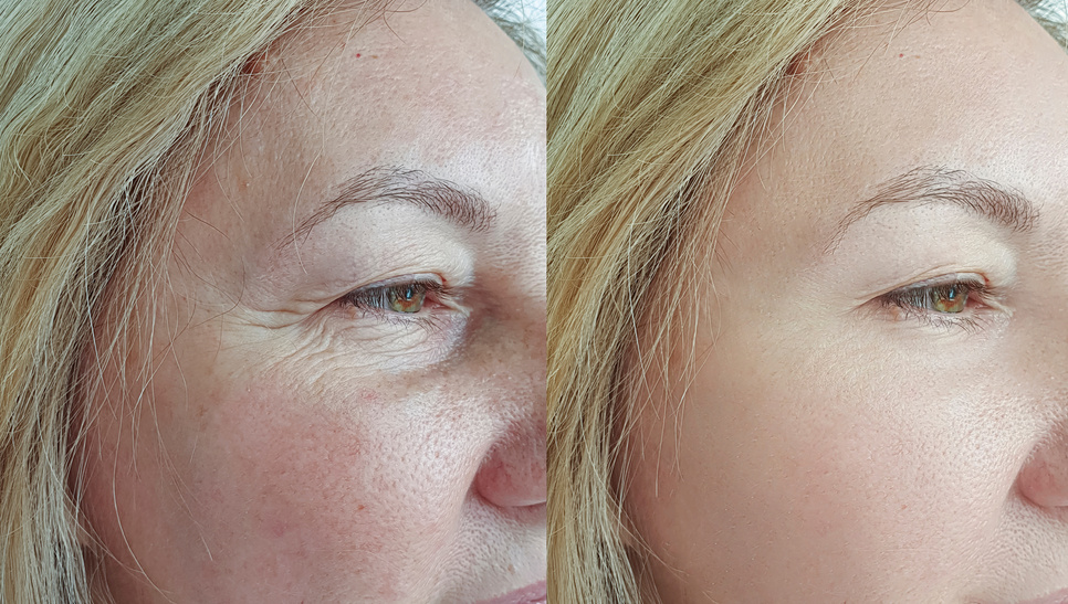 elderly woman face wrinkles before and after treatment